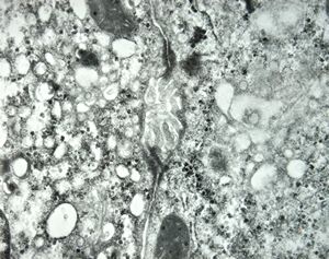 M,15y. | normal primary bile duct M,15y. | normal primary bile duct